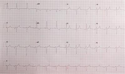 Different mechanisms of mitral regurgitation in hypertrophic cardiomyopathy: A clinical case and literature review